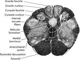 Lateral medullary syndrome (aka pica syndrome or wallenburg syndrome) 1. Medulla Oblongata An Overview Sciencedirect Topics