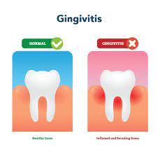 Gum Disease Treatment In New York City | Marc Lazare D.d.s., M.a.g.d.