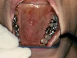 Image result for Oral thrush roof of mouth