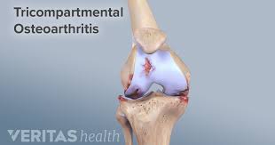 Knee Osteoarthritis Symptoms