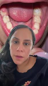 Todays tidbit…. Why your kids tooth is coming out behind the baby tooth!  #dentist #dentistofinstagram