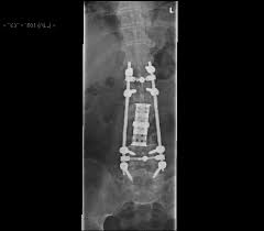 This is because they can be hard to diagnose and treat. Https Www Longdom Org Open Access An Atypical Presentation Of Chordoma Case Report And Review 2161 0533 1000247 Pdf