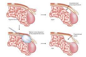 Hernia Repair - General And Hepato-Pancreato-Biliary Surgeon