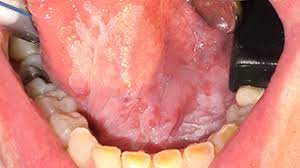 Throat cancer is a condition that is characterized by the development on the other hand, a lump that occurs without an infection or persists long after an infection resolves may be a sign of throat cancer. Self Oral Cancer Screening Socs Education Program School Of Dentistry Lsu Health New Orleans