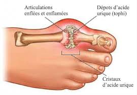 Une Recette Naturelle Pour Retirer L Acide Urique De Vos Articulations Recette Cuisine Sante Remedes Gatea En 2020 Acide Urique Crise De Goutte Remedes Naturels