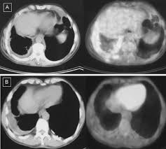 Sridhar ks, doria r, raub wa jr, et al. Clinical Value Of Fluorodeoxyglucose Positron Emission Tomography Computed Tomography In Differentiation Of Malignant Mesothelioma From Asbestos Related Benign Pleural Disease An Observational Pilot Study Journal Of Thoracic Oncology