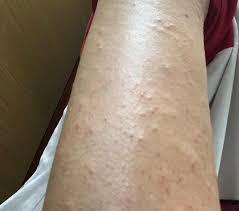 Determining whether you have had an allergic reaction to sunscreen as opposed to some other irritant can be difficult, as sun exposure and wind alone can cause skin symptoms in sensitive individuals. Singapore Mum Warns About Sunscreen Allergy After Child Suffers Swollen Face And Rashes