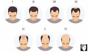Sebab tula rambut senang gugur. íŠ¸ìœ„í„°ì˜ Hair Place Malaysia ë‹˜ Male Pattern Baldness Kebotakkan Pada Lelaki Juga Dikenali Sebagai Androgenic Alopecia Adalah Salah Satu Punca Rambut Gugur Yang Melibatkan Lelaki Mengikut Kajian Sebanyak 50 Lelaki Yang Berusia