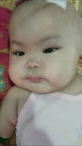 Baby Enid's Life-Changing Surgery