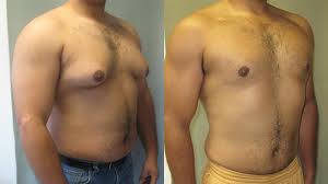 Gynecomastia Latest Treatment 2024