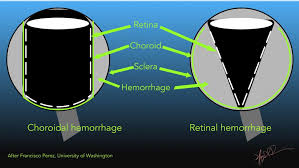 Image result for Hemorrhage Classification