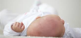 What are the symptoms of a healthy baby during pregnancy? When A Baby S Head Is Misshapen Positional Skull Deformities Healthychildren Org