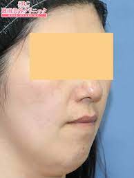症例写真 no 227151 宮多和浩 医師による脂肪吸引 湘南美容クリニック 脂肪吸引 美容クリニック 美容