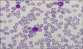 Image result for Peripheral Smear