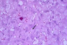 Check spelling or type a new query. Hepatitis B Practice Essentials Background Pathophysiology