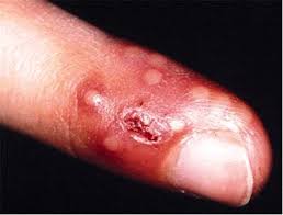 Hand rashes are a widespread problem because the hands come into contact with wind, dry air, soap, and many other irritating substances. Herpetic Whitlow Hand Orthobullets