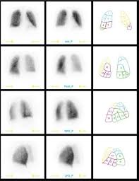 Image result for Ventilation Perfusion Scan