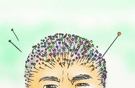 I've never seen this first hand however if acupuncture is meant to stimulate the body for positive results then you would have to include hair growth. Acupuncture For Hair Growth Benefits Results Hairguard