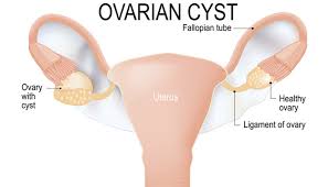 Image result for Cyst