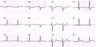 (sociedade europeia para directrizes de. Consideracoes Eletrocardiograficas Sobre A Cardiopatia Isquemica