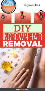 Ingrown Hair Removal Natural Remedy For Ingrown Hair With Essential Oil Ingrown Hair Treatment Ingrown Hair Ingrown Hair Removal