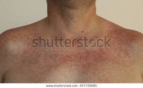 Image result for Photodermatitis