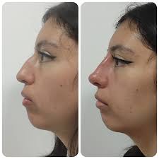 ✨ Transforma tu perfil sin cirugía con nuestra Rinomodelación ✨ Logra una  nariz armónica y definida con el tratamiento del Dr. Gustavo Ulloa, experto  en estética facial. Cambios naturales, rápidos y sin