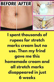 I Spent Thousands Of Rupees For Stretch Marks Cream But No Use Then My Frind Gave Me This Homemade Stretch Mark Cream Stretch Mark Removal Cream Stretch Marks