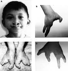 Analysis Of The P63 Gene In Classical Eec Syndrome Related Syndromes And Non Syndromic Orofacial Clefts Journal Of Medical Genetics
