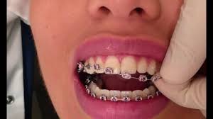 After a cleaning, the conditioning can take anywhere from ten to thirty minutes. How Braces Are Removed Youtube