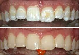 Dental Tooth Bonding Cosmetic Dentist Orange Woodbridge Milford Ct Teeth Bonding Dental Dental Teeth