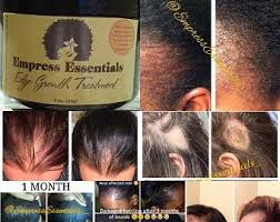 Hair Loss Treatment Hair Growth Cream 1 Month Supply Balding Etsy Hair Growth Cream Growth Oil Hair Growth Faster