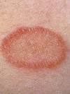 Fungal Dry Skin Patches