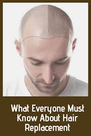 What Everyone Must Know About Hair Replacement Hair Transplant Dubai Hair Replacement Hair Transplant Hair Loss Men