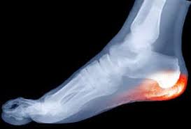 Image result for Calcaneal Apophysitis