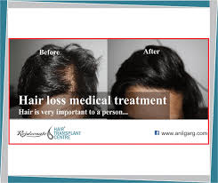 Medial Treatment for Hair Loss and Hair Fall - Rejuvenate