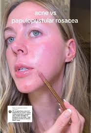 Understanding Rosacea: Symptoms and Types Explained