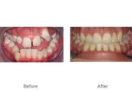 Braces Beforeandafter Orthodontists Orthodontics Orthodontics Orthodontist Family Dentistry