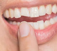 Even Celebrities Have Accidents See What They Do To Restore Their Chipped Teeth Image Dental