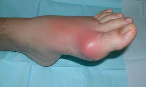 Check spelling or type a new query. Gouty Tophi Causes Symptoms Diagnosis Treatment