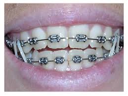 Alat penjagaan braces ini anda boleh dapati dengan mudah di apa yang penting adalah gigi bersih dan tidak berbau, konsepnya sama seperti sebelum anda memakai pendakap gigi braces tu. Brother In The House Hari Pertama Pakai Braces