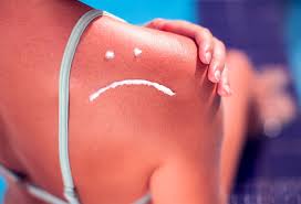 Image result for Sunburn