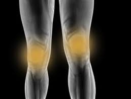 Les gonflements du genou sont des réactions rencontrées chez de nombreuses personnes. Douleurs Du Genou Symptomes Traitement Definition Docteurclic Com