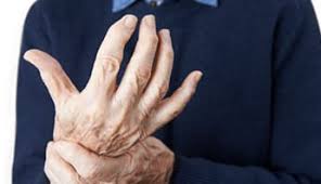 L'arthrite, qui peut être aiguë (crise de goutte par exemple) ou chronique (polyarthrite rhumatoïde par exemple). Arthrose Des Doigts Pourquoi Que Faire Dossier Special Articulation Arthrolink