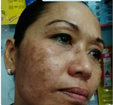 If yes, you are in the right place. Bahana Salah Oriebel Cara Hilangkan Jeragat Jerawat Facebook