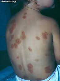 Image result for Urticaria pigmentosa children