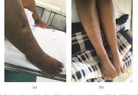 It is caused by fluid buildup in the baby, called hydrops. Figure 2 From Mirror Syndrome In Monochorionic Twin Pregnancy With Acardiac Fetus Semantic Scholar