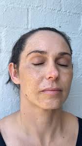 Improving pigmentation is not easy