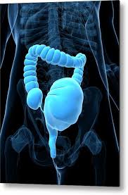 Image result for Megacolon