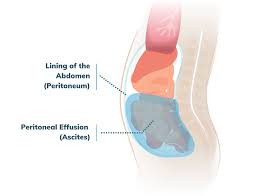Most symptoms present in the abdominal region. Peritoneal Effusion Common Mesothelioma Symptoms